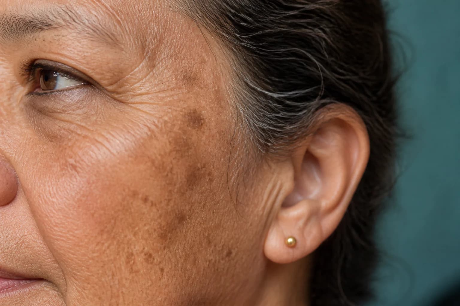 Illustrative close view of mature sun-exposed skin with mottled pigment, fine lines, and coarse texture.